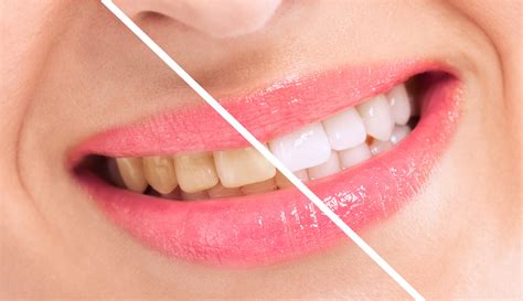 Professional Teeth Whitening Procedure | Springvale Dental