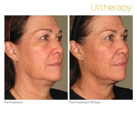 Ultherapy – Why are there mixed reviews? - BLUME