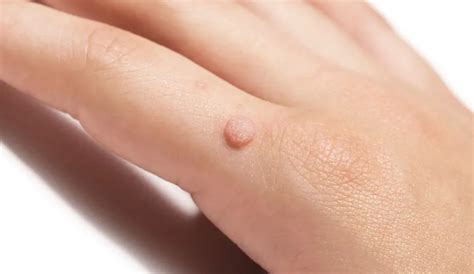 Expert Wart Removal Services in Adelaide - Safe and Effective Treatments