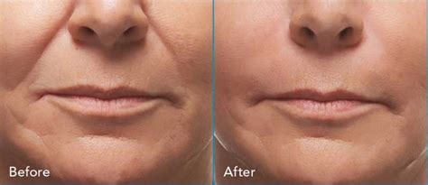 Radiesse® Treatment New York - Laser & Mohs Dermatology