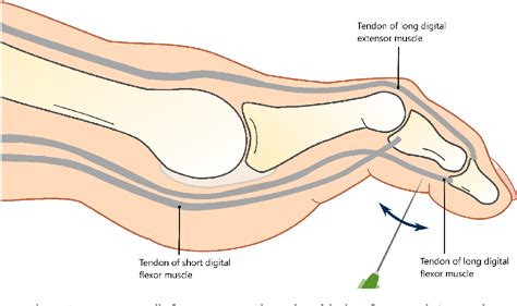 The efficacy of flexor tenotomy to prevent recurrent diabetic foot ...