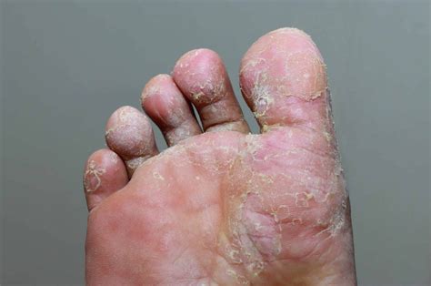 The Types of Fungal Foot Infections - A Podiatrist's Guide