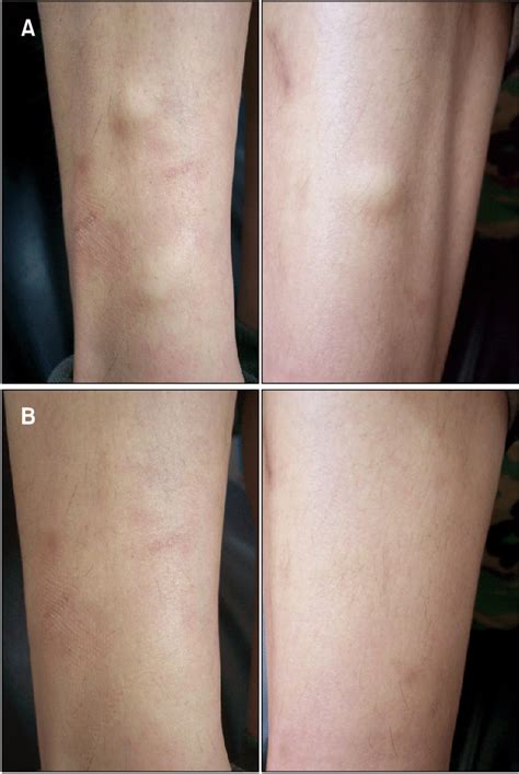 Subcutaneous Skin Nodules