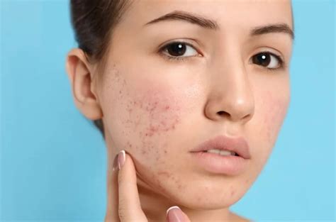 Acne Scars | Kovak Cosmetic Center Chicago Illinois