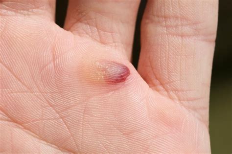How To Heal Blood Blisters - Skirtdiamond27