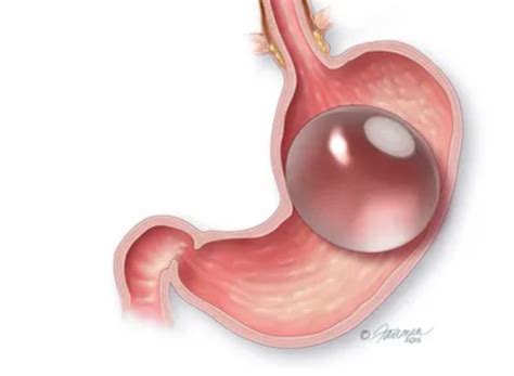 Orbera Intragastric Balloon