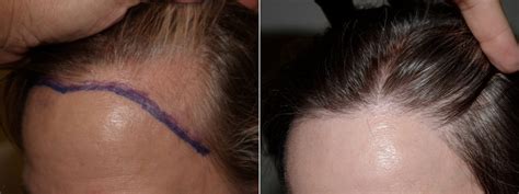 Hair Transplants for Women Before and After Photos - Foundation For ...