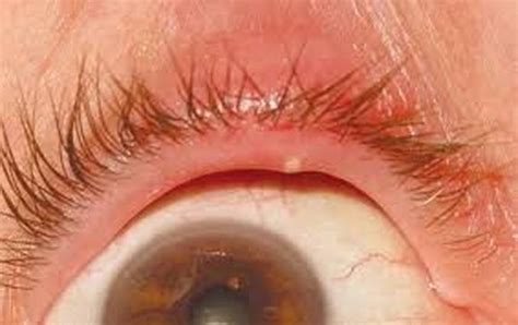 Picture of Stye / Chalazion