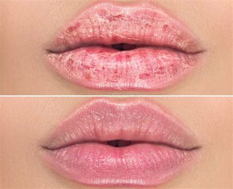 How To Take Care Of Cracked Lips At Home | HerZindagi