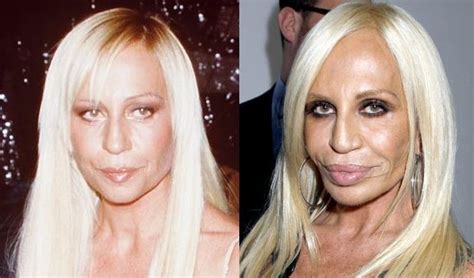 Donatella Versace before and after plastic surgery 01 – Celebrity ...