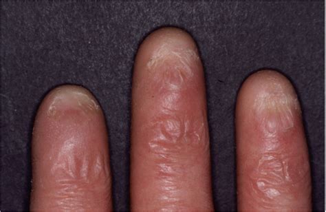 Dyskeratosis Congenita