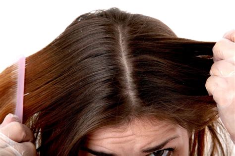 Dandruff vs. Dry Scalp: What's the Difference? - Medrot.com