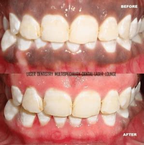 Laser treatment for black gums – Dr. Sana Farista