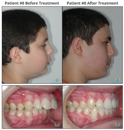 Overbite Before And After Profile