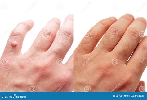 Laser Treatment for Wart Removal before and after. Stock Image - Image ...