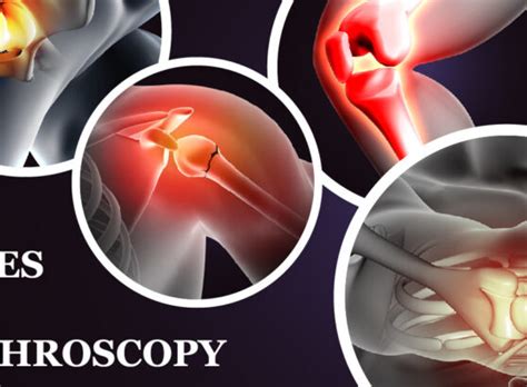 Arthroscopy: Purpose & Procedure – Welcome to SYS Medtech International ...