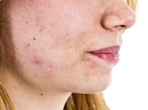 Frustrated by Folliculitis? - DrWeil.com