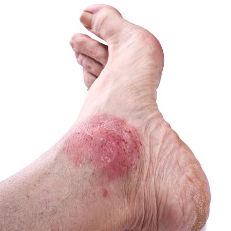 Is Your Foot Rash Psoriasis? | Syracuse Podiatry - Dr. Ryan D'Amico