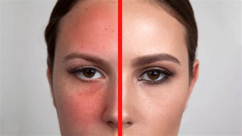 Rosacea Treatment Bristol - Ciao Bella Aesthetics