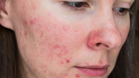 Acne Takes A Toll On Women's Mental Health, Quality Of Life | Faculty ...