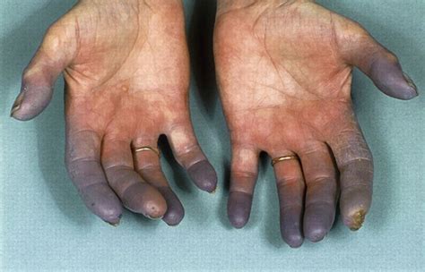 Diagnosis and management of Raynaud’s phenomenon | The BMJ