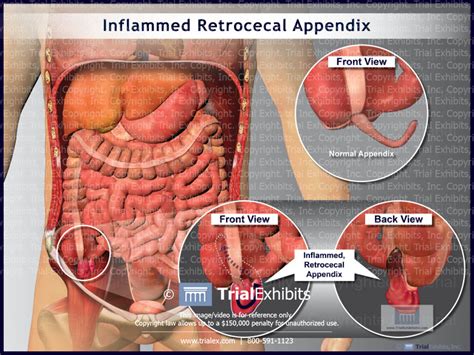 Inflamed Retrocecal Appendix - TrialQuest Inc.