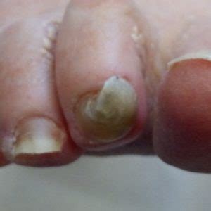 Twisted Toe Nails - Footman Podiatry and Gait Analysis Clinics
