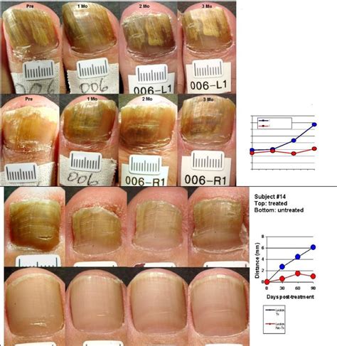 Toenail Fungus Treatment Research at Oliver Robinson blog