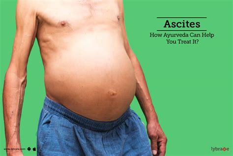 Ascites Causes Pictures Symptoms And Treatment