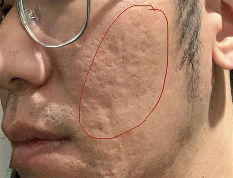 Suggestions needed for acne scars with history of keloid - Scar treatments - Acne.org