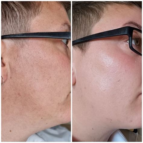 [Before&After] 3 Months Tretinoin : r/SkincareAddiction