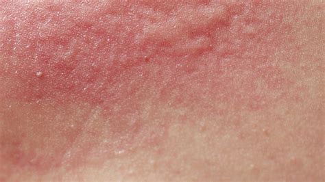 What Is Dermatitis? Causes, Treatments & Advice For Irritated Skin ...