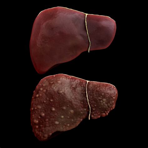 Comparison of a Healthy Liver and one Damaged by Cirrhosis - ZBrushCentral