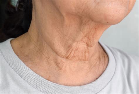 9 Tips and Home Remedies for Neck Wrinkles – Say Bye to Neck Lines! - Healthwire