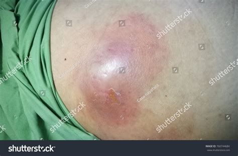 Abdominal Wall Abscess Stock Photo 760744684 | Shutterstock