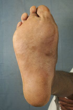 Actinomycetoma Right Foot Mycetoma Uncommon Disease Editorial Stock Photo - Stock Image ...