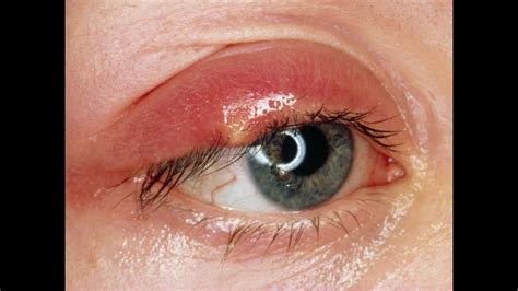 Eyelid Cyst