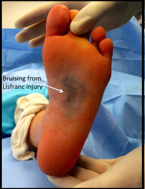 Lisfranc Injury - FootEducation