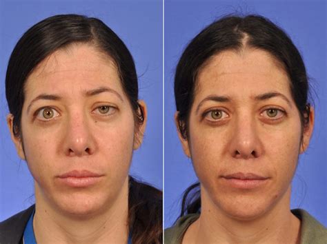 Thyroid Eye Disease Before and After | W Cosmetic Surgery