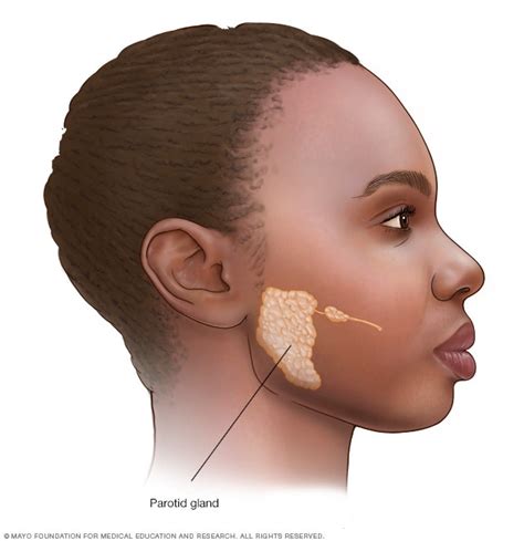 Parotid tumors - Overview - Mayo Clinic