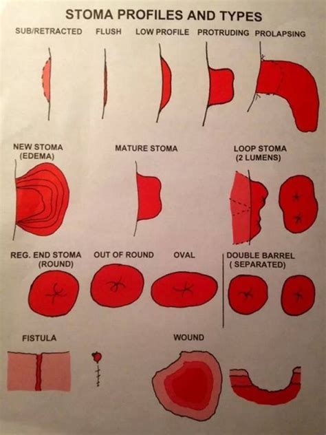 Types Of Stomas Images at Jackie Speer blog