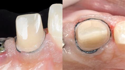 Dental basics: Gingival Retraction - The two cord technique - YouTube