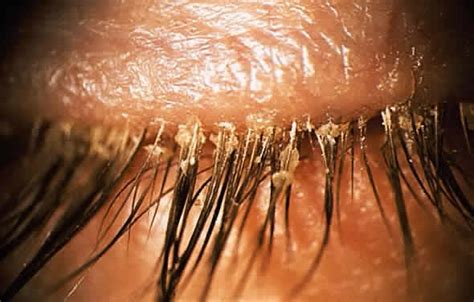 25 Unique Demodex Folliculorum Pictures - Demodectic Mange