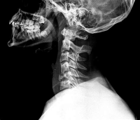 Neurocirugía Rosario: Traumatismo cervical