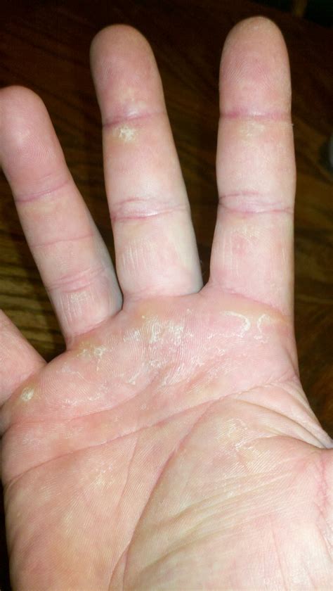 Callus Tear Prevention - Taking Care of Hand Skin - Diesel Crew - Muscle Building, Athletic ...