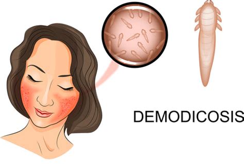 Demodex Mites and Rosacea: Treatment Methods and Causes | SK Guest Posting
