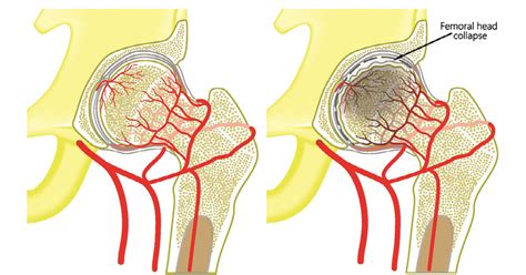 Avascular Necrosis: Symptoms, Causes, Diagnosis, Treatment & Prevention