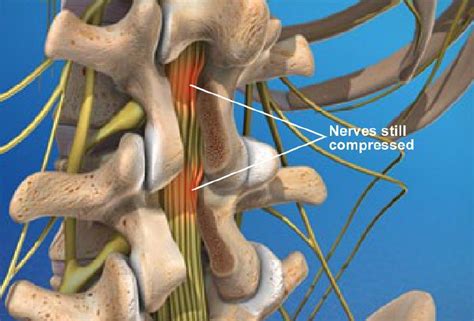 Post-laminectomy syndrome 2 | STL MISC