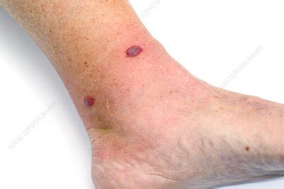 Cellulitis after insect bite - Stock Image - C023/8972 - Science Photo ...