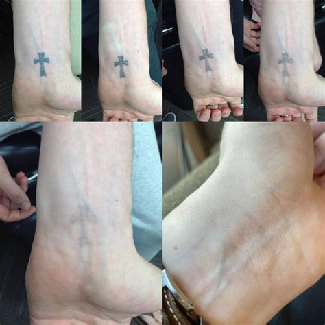 Before and After Photos - InkAway Laser Tattoo Removal